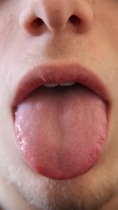Mundhöhlenkrebs bilder Zungengrundkrebs Symptome
