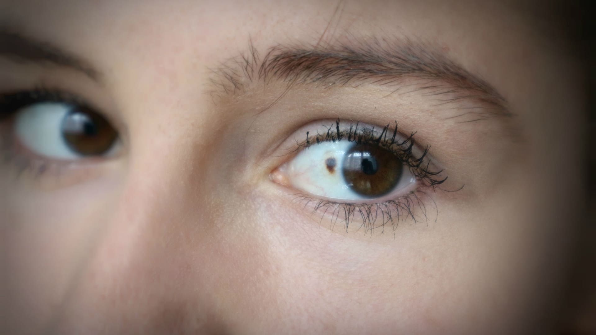 Was sind Ursachen und Behandlung von einem rotem Fleck im Auge?