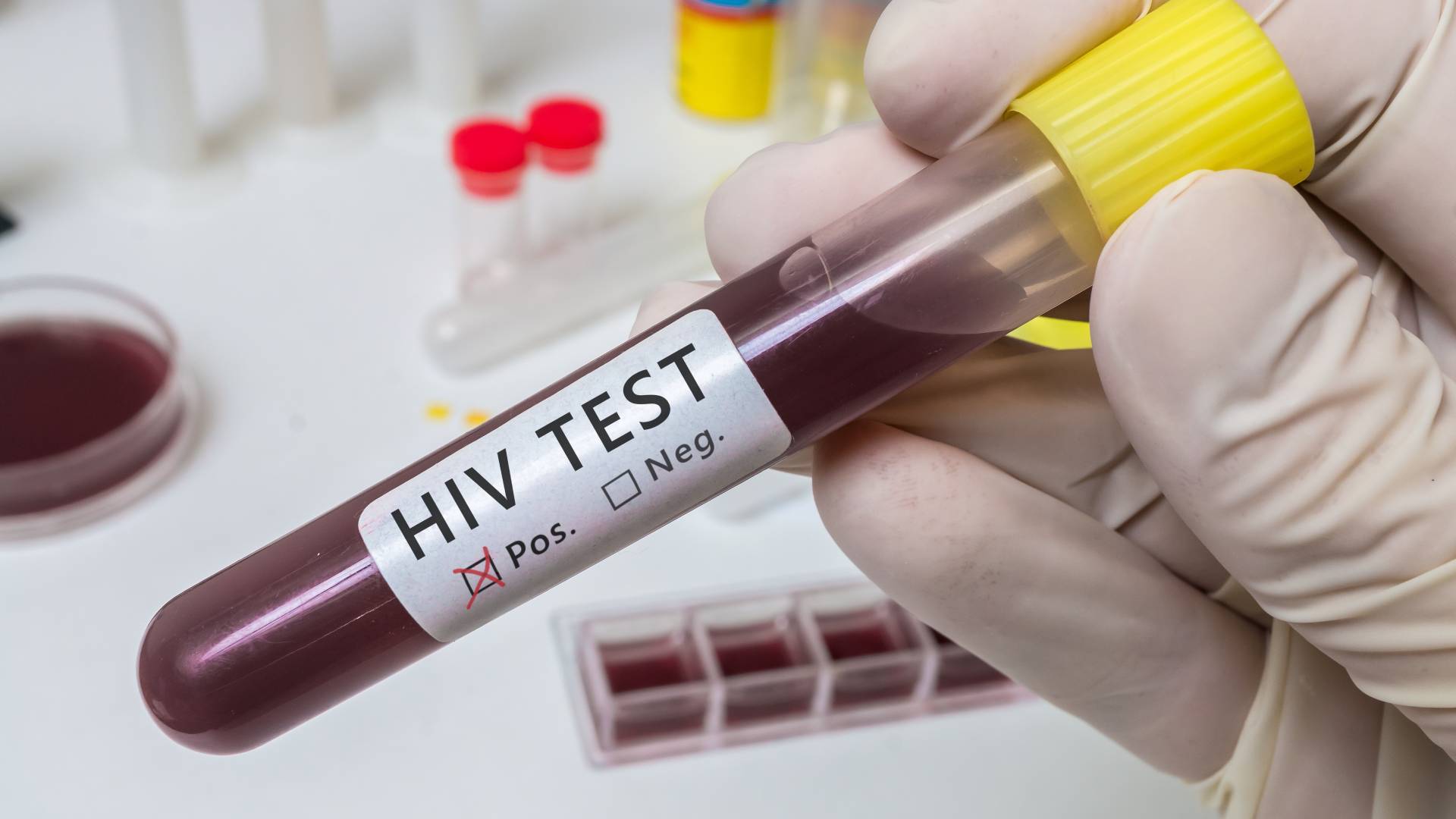 Eine Neue HIV-Variante wurde in den Niederlanden entdeckt