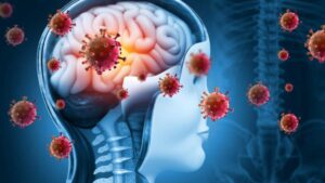 Alzheimer könnte als Folge einer Infektion mit dem Windpocken- und Gürtelrosevirus auftreten