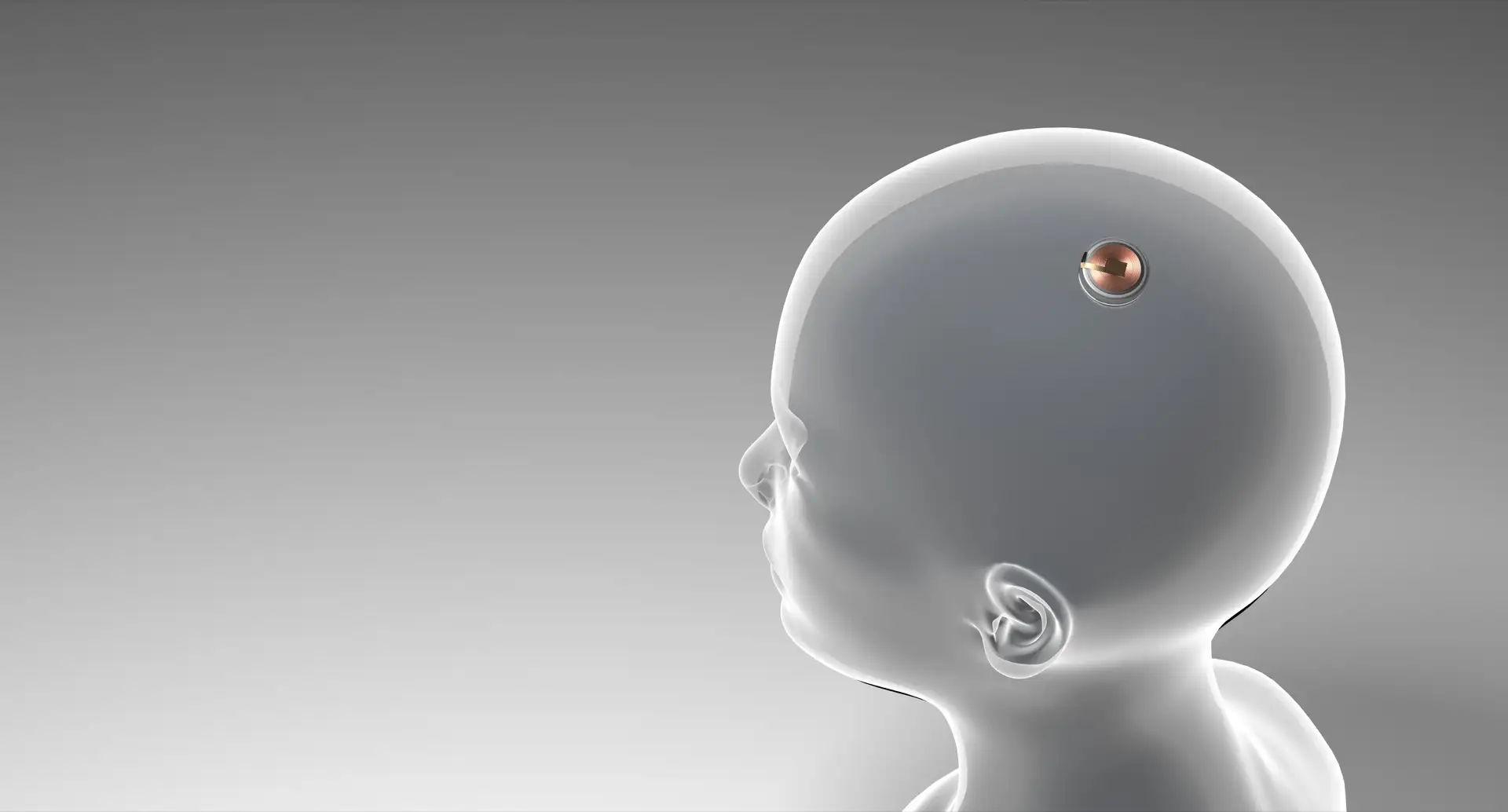 neuralink implant cerebral elon musk - Neuralink: Elon Musk will Blinden das Augenlicht schenken und Gelähmte zum Laufen bringen.