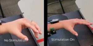 avc stimulation moelle epiniere 300x147 - Schlaganfallüberlebende können ihre Arme dank einer Stimulation des Rückenmarks wieder benutzen.